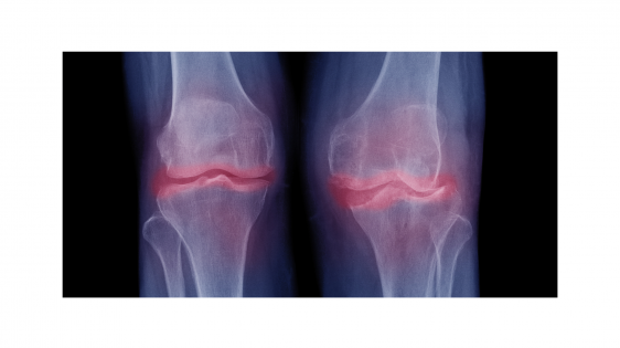 X-ray image of both knees with osteoarthritis